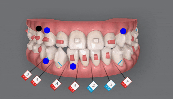 주걱턱 반대교합도 잠실인비절라인 잠실교정치과 유펜바른치과에서!(비발치주걱턱교정 잠실성인교정 반대교합인비절라인 잠실교정치과 주걱턱교정후기) 관련 이미지 16