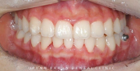 '웃을때 입을 자꾸 가려요'  활짝 웃은 중학생 비발치 인비절라인후기 (잠실새내인비절라인 청소년인비절라인 잠실교정치과) 관련 이미지 11