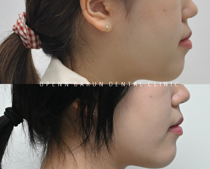 반대교합+개방교합 비수술교정 유펜바른치과에서 재교정한 후기! ( 비발치개방교합 비발치반대교합 재교정후기 잠실교정치과 미니스크류비수술교정 악궁확장장치 MARPE) 관련 이미지 11