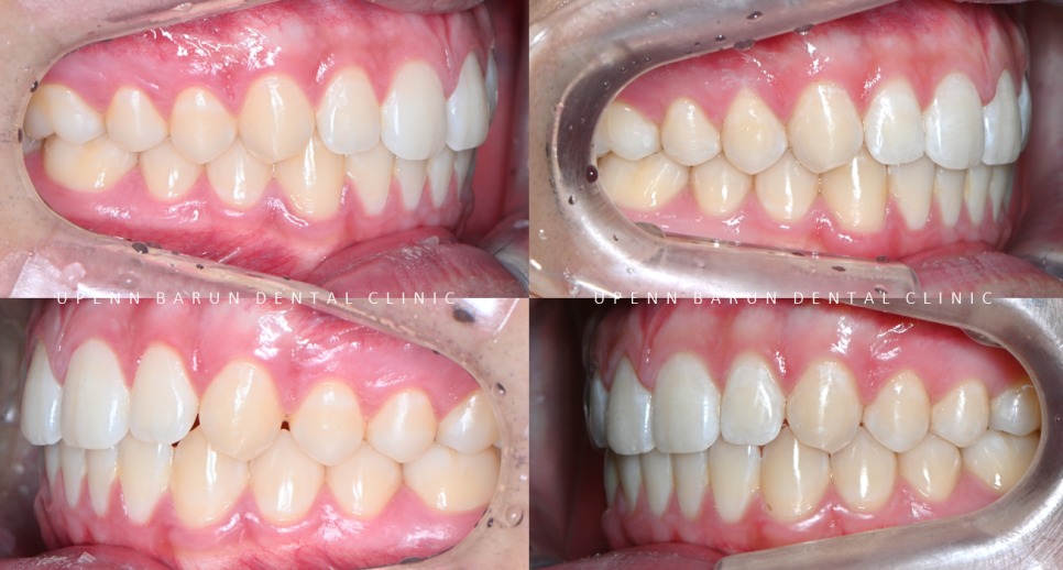 인비절라인다이아몬드등급치과에서 7주만에 앞니벌어짐 고민 해결한 후기(인비절라인앞니교정 인비절라인익스프레스 잠실인비절라인 인비절라인앞니교정후기) 관련 이미지 11