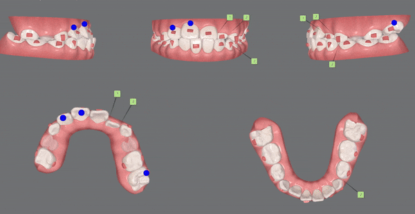 8세 어린이반대교합 인비절라인퍼스트로 수월하게 해결 후기! 잠실인비절라인퍼스트 잠실인비절라인소아교정 (잠실교정치과 잠실인비절라인 인비절라인등급 인비절라인후기 잠실소아교정) 관련 이미지 10