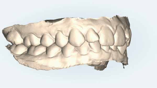 비발치 세라믹교정 후기 (앞니교정 잠실부분교정 잠실교정치과 잠실새내교정치과) 관련 이미지 3