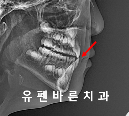 아이가 반대교합(주걱턱)인데 1차교정을 꼭해야 하나요? 관련 이미지 9