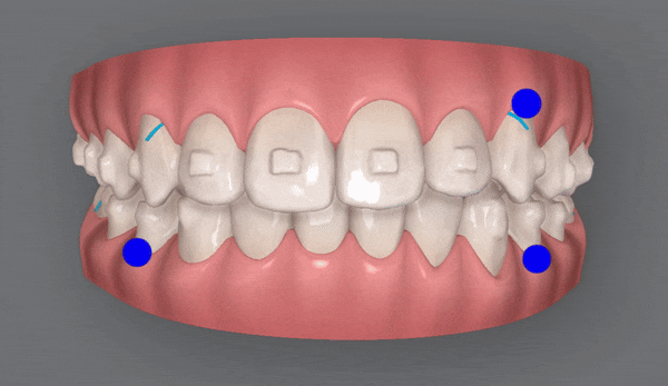 잠실소아인비절라인 잠실어린이인비절라인 송파인비절라인 잠실인비절라인후기 (잠실새내교정치과 엘스상가교정치과 파인애플상가교정치과 잠실새내역인비절라인 청소년교정후기 잠실인비절라인퍼스트) 관련 이미지 11