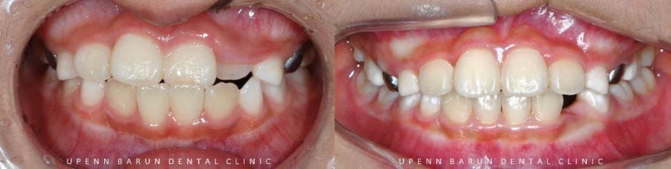8세 어린이반대교합 인비절라인퍼스트로 수월하게 해결 후기! 잠실인비절라인퍼스트 잠실인비절라인소아교정 (잠실교정치과 잠실인비절라인 인비절라인등급 인비절라인후기 잠실소아교정) 관련 이미지 15