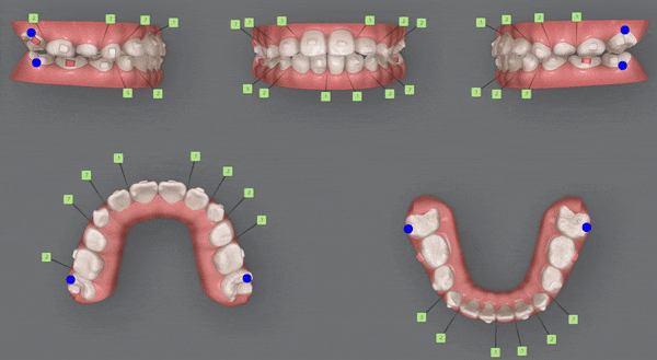 8세 어린이반대교합 인비절라인퍼스트로 수월하게 해결 후기! 잠실인비절라인퍼스트 잠실인비절라인소아교정 (잠실교정치과 잠실인비절라인 인비절라인등급 인비절라인후기 잠실소아교정) 관련 이미지 13