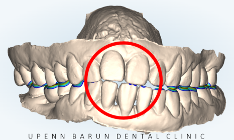 인비절라인 공식 스피커가 상주하고 치료하는 송파교정잘하는치과 유펜바른치과 (잠실성인교정 잠실재교정 잠실인비절라인 성인인비절라인교정 잠실나루역교정치과 문정동교정치과 삼전역교정치과) 관련 이미지 4