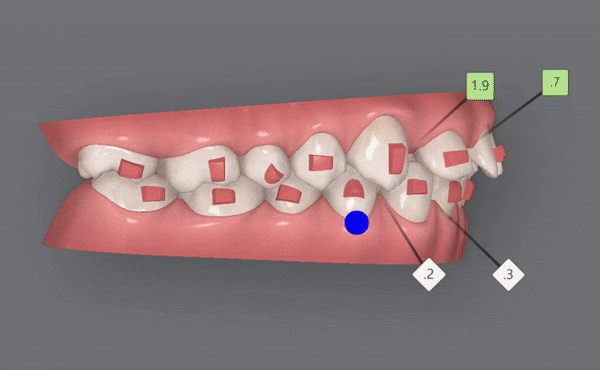 잠실인비절라인등급 잠실부분교정 앞니틈교정 인비절라인라이트 옵션으로 빠르게 해결한 후기 (삼성역부분교정 인비절라인앞니재교정 잠실역교정치과 삼전동인비절라인 삼전동교정치과) 관련 이미지 7