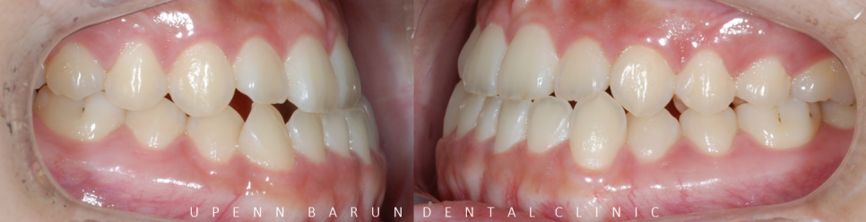 주걱턱교정, 수술교정, 양악수술도 잠실교정치과 유펜바른치과에서 관련 이미지 5