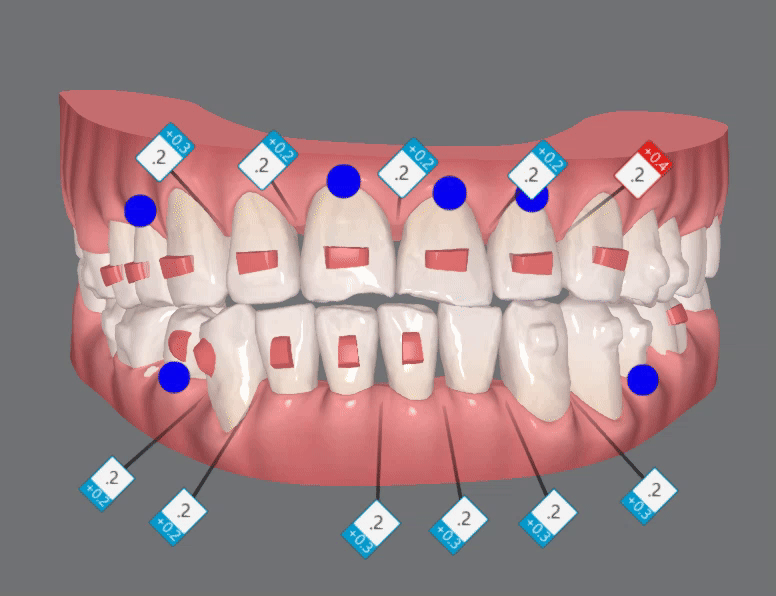 평생 삐뚤어진 치아가 고민이셨던 79세 고령환자분이 선택한 송파인비절라인다이아몬드등급 후기 (서울인비절라인전문치과 잠실인비절라인교정치과 노인교정 노인치아교정 노인교정치과) 관련 이미지 13
