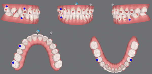 나스닥에 상장한 인비절라인, 잠실투명교정 잠실인비절라인 후기와 치아미백이 궁금하다면? 관련 이미지 10