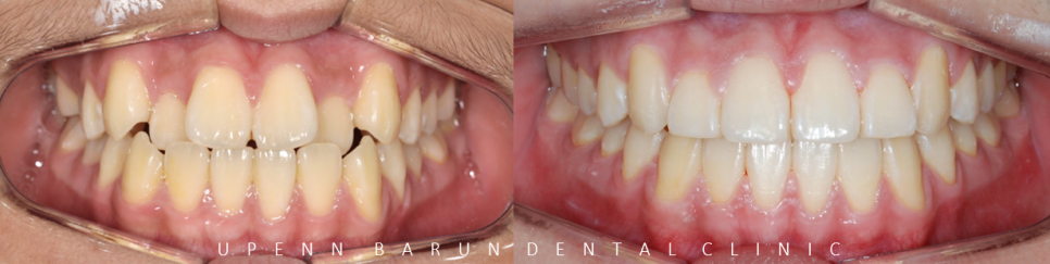 비발치교정 성장기교정 청소년치아교정은 잠실교정치과 유펜바른치과에서 관련 이미지 6