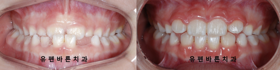 아이가 반대교합(주걱턱)인데 1차교정을 꼭해야 하나요? 관련 이미지 8