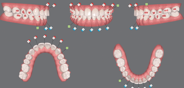 예전에 교정했는데 앞니가 뻐드러져서 컴플렉스에요! ( 비발치교정 인비절라인으로 재교정 해볼까요?) 관련 이미지 8