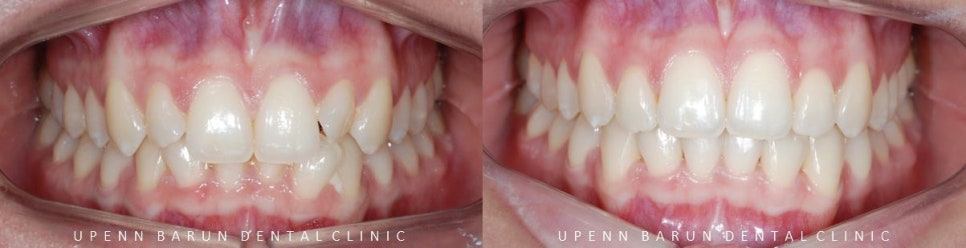 비발치 세라믹교정 후기 (앞니교정 잠실부분교정 잠실교정치과 잠실새내교정치과) 관련 이미지 4