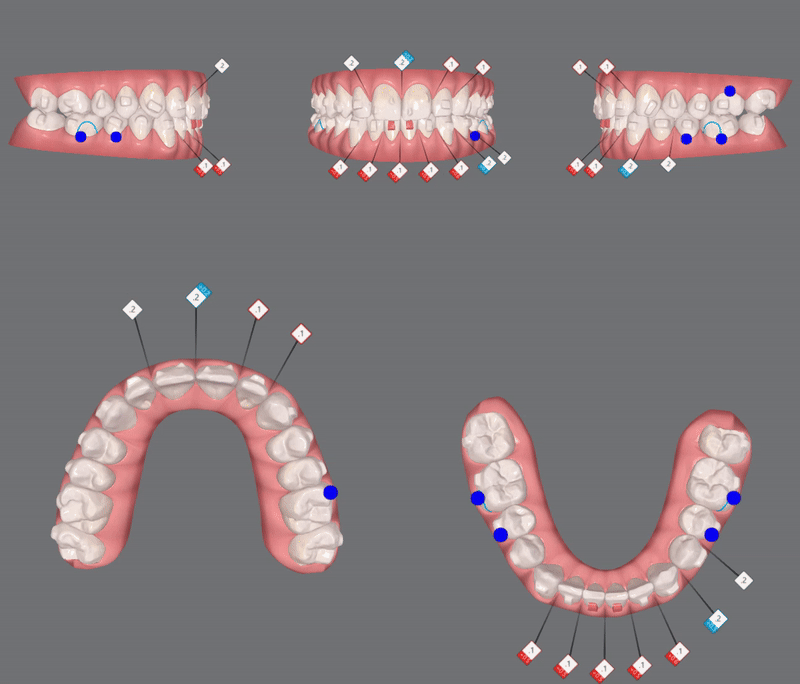 '옥니같이 보여요' 인비절라인급속교정 가능할까? with 캐리에모션장치 (잠실다이아몬드등급 인비절라인다이아몬드등급 서울다이아몬드등급치과 옥니인비절라인후기) 관련 이미지 15