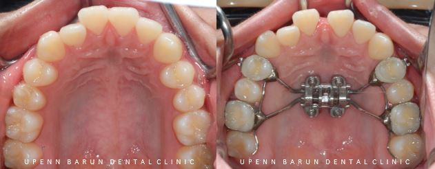 ABO 미국 치과교정과 전문의의 비수술치아교정 악궁확장장치 후기 (잠실교정전후 잠실새내교정치과 잠실교정치과 교정통증  앞니 변화) 관련 이미지 13