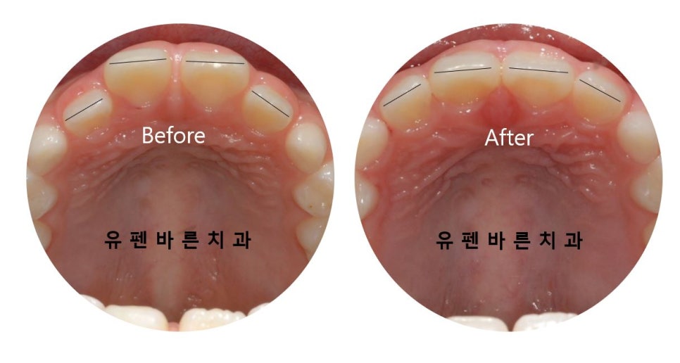 저도 친구들이 많이 하는 인비절라인교정 하고싶어요! 관련 이미지 10