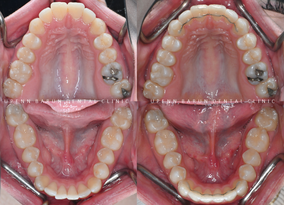 가지런했던 앞니가 삐뚤빼뚤해졌어요! 잠실다이아몬드등급 잠실인비절라인 인비절라인익스프레스 앞니 삐뚤어짐 해결(앞니급속교정 앞니투명교정 인비절라인급속교정 인비절라인전후사진) 관련 이미지 12
