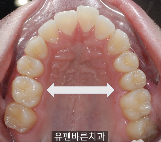 앞니끼리 맞물리지 않는데 인비절라인으로 교정 가능한가요? 관련 이미지 4