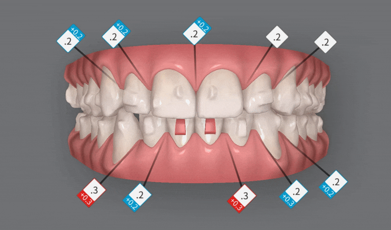인비절라인다이아몬드등급치과에서 28개의 교정장치로 고민 해결한 후기가 궁금하다면? (잠실송곳니덧니교정 잠실인비절라인 인비절라인교정기간 투명교정장치후기 잠실인비절라인후기) 관련 이미지 8