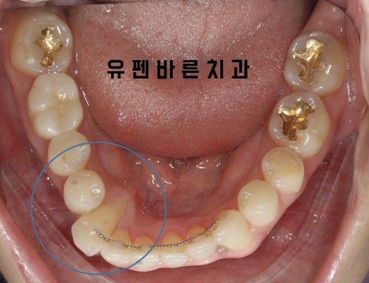 앞니부분교정 잠실인비절라인 라이트 옵션 들어보셨나요? 관련 이미지 3