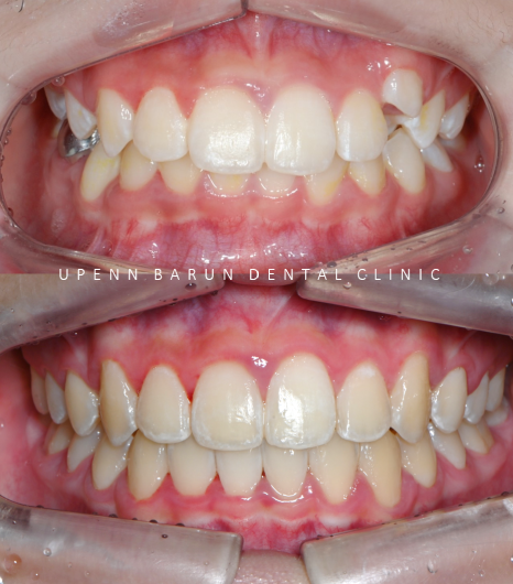 잠실소아인비절라인 잠실어린이인비절라인 송파인비절라인 잠실인비절라인후기 (잠실새내교정치과 엘스상가교정치과 파인애플상가교정치과 잠실새내역인비절라인 청소년교정후기 잠실인비절라인퍼스트) 관련 이미지 18