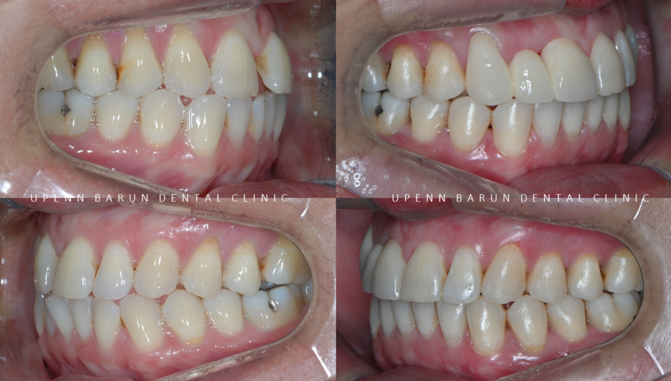 같은원장님께 보철치료와 교정치료를 동시에! 앞니사이 틈 해결한 후기 ( 송파교정치과 잠실교정잘하는치과 송파교정잘하는치과 올림픽파크포레온교정치과 올림픽파크포레온인비절라인치과) 관련 이미지 9