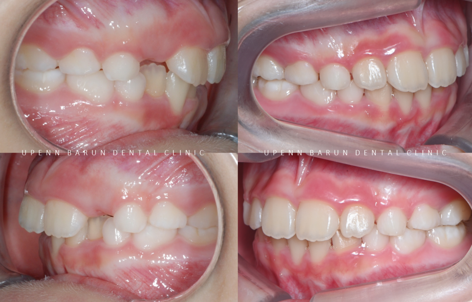 송파인비절라인퍼스트 인비절라인어린이교정 11개월만에 끝낸 후기(잠실인비절라인 잠실파인애플상가교정치과 인비절라인소아교정후기 인비절라인플래티넘엘리트등급) 관련 이미지 19