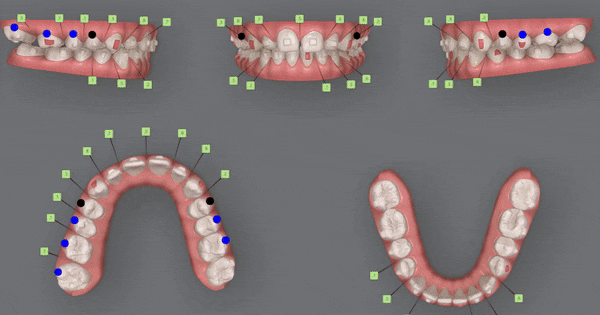 인비절라인높은등급 인비절라인플래티넘엘리트 잠실교정치과 잠실인비절라인 (잠실교정치과 송파인비절라인 인비절라인전후사진 인비절라인후기) 관련 이미지 13
