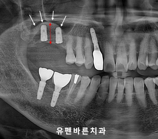 상악동 때문에 대학병원가서 임플란트 하라고 권유받으신 분들 필독!!! 관련 이미지 7