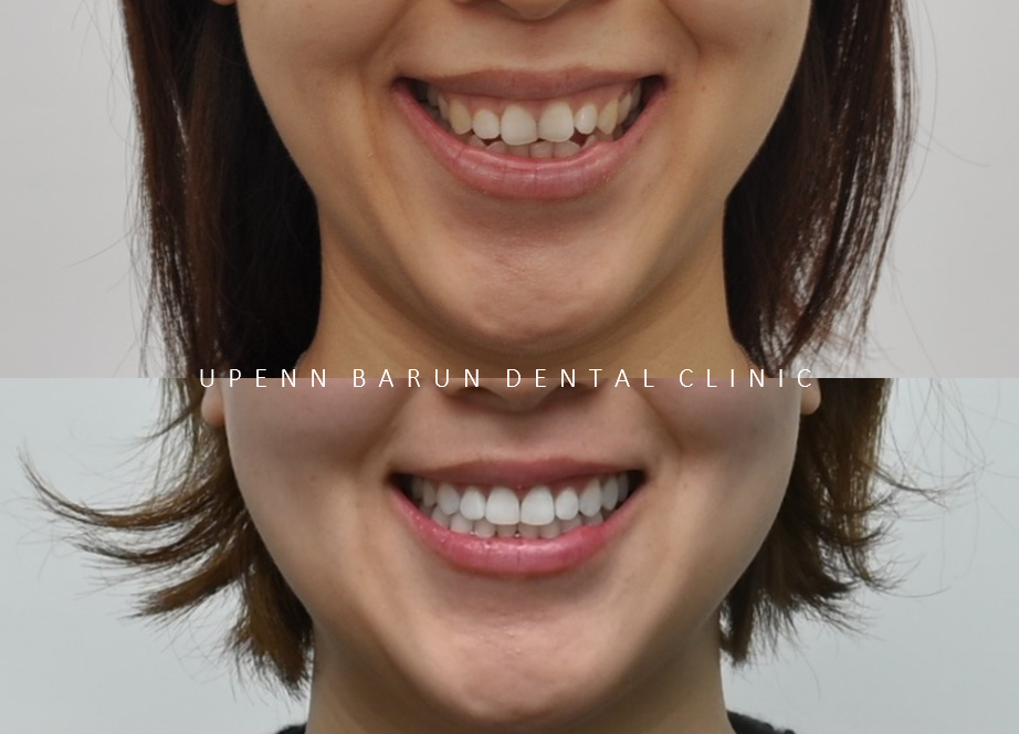 잇몸웃음 거미스마일(gummy smile) 교정후 입동굴 예쁜미소로!(잠실교정치과 거미스마일교정후기 거미스마일교정전후 클라리티세라믹교정 미니스크류교정 미국치과교정과전문의) 관련 이미지 6
