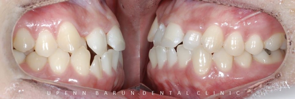 잠실데이몬교정, 비발치교정, 잠실덧니교정 (AKA Damon Smile) 관련 이미지 8