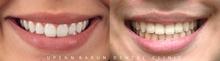 유학생치아교정 유학생교정치과 잠실교정치과 잠실데이몬교정 데이몬클리어교정 Wide Smile (송파교정치과 잠실새내교정치과 강동교정치과 헬리오시티교정치과 예쁜미소 Smile Arc) 관련 이미지 17