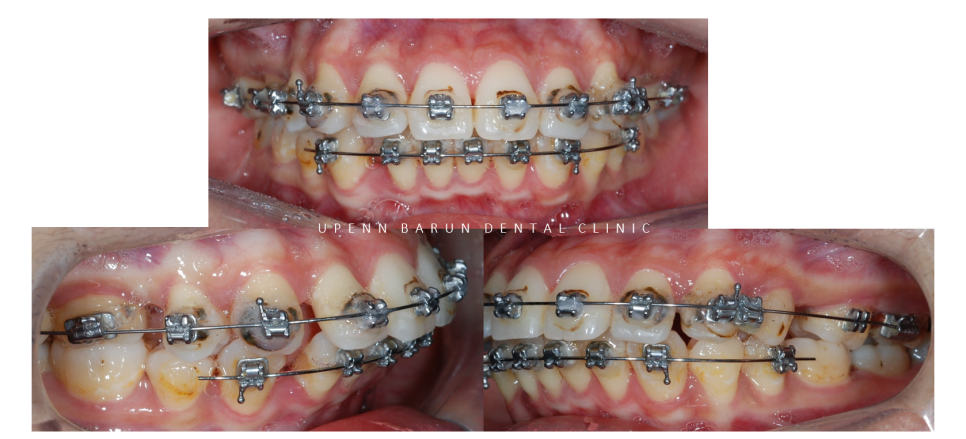 수술이 필요없는 잠실돌출입교정 잠실교정치과 입술이 잘 안다물어져 고민이라면? (돌출입전후 잠실새내교정치과 잠실발치교정 발치교정전후사진) 관련 이미지 4