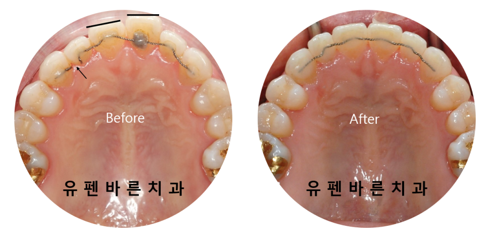 인비절라인으로 재교정, 가능할까용?? 관련 이미지 7