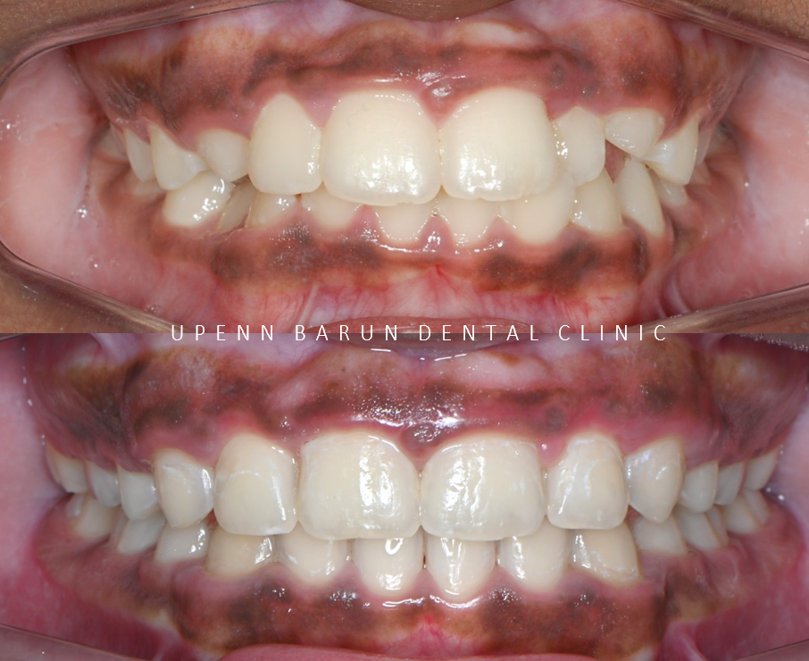 성장기에 돌출입이 고민이라면? 돌출입청소년교정 입술무력증 해결도 유펜바른치과에서! (잠실청소년교정 잠실돌출입교정 돌출입교정기간 발치교정외모변화 외국인교정치과) 관련 이미지 8