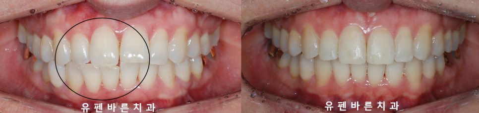 인비절라인으로 재교정, 가능할까용?? 관련 이미지 9