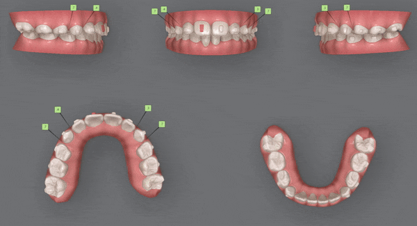 송파인비절라인퍼스트 인비절라인어린이교정 11개월만에 끝낸 후기(잠실인비절라인 잠실파인애플상가교정치과 인비절라인소아교정후기 인비절라인플래티넘엘리트등급) 관련 이미지 18