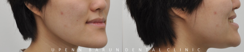 주걱턱교정, 수술교정, 양악수술도 잠실교정치과 유펜바른치과에서 관련 이미지 2