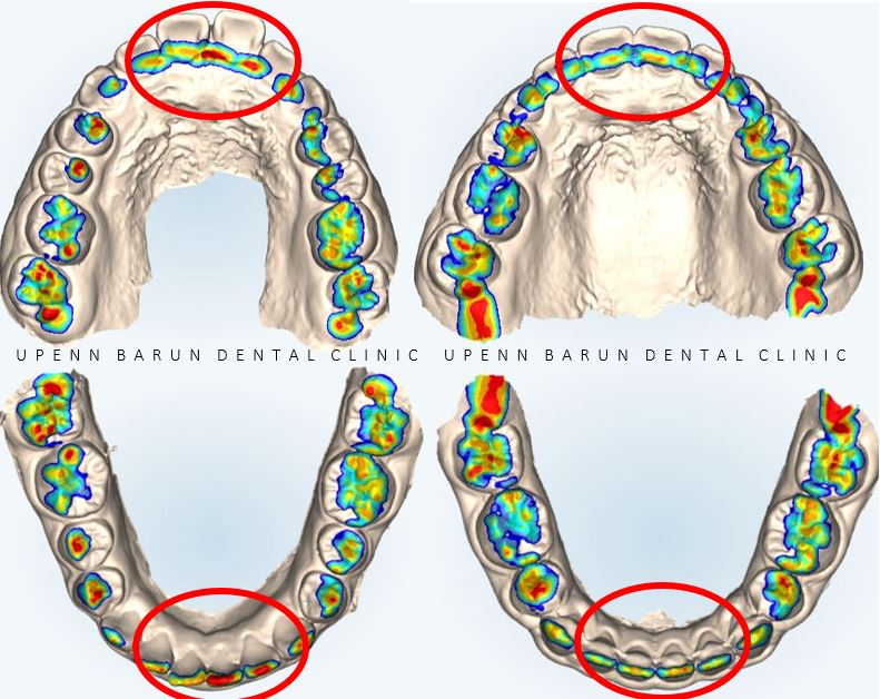 잠실새내역청소년교정 잠실돌출입발치교정은 유펜바른치과!(잠실중학생발치교정 잠실무턱교정 잠실새내소아교정치과 잠실새내교정잘하는치과 발치교정외모변화) 관련 이미지 8