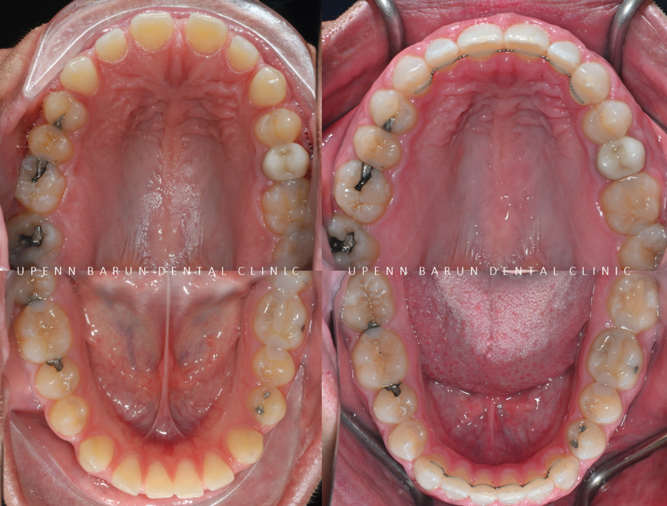 인비절라인높은등급 인비절라인플래티넘엘리트 잠실교정치과 잠실인비절라인 (잠실교정치과 송파인비절라인 인비절라인전후사진 인비절라인후기) 관련 이미지 16