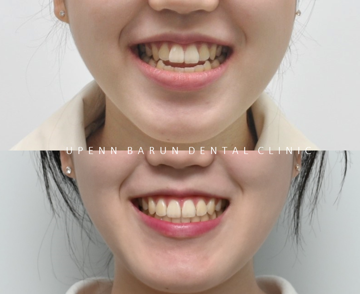 반대교합+개방교합 비수술교정 유펜바른치과에서 재교정한 후기! ( 비발치개방교합 비발치반대교합 재교정후기 잠실교정치과 미니스크류비수술교정 악궁확장장치 MARPE) 관련 이미지 12