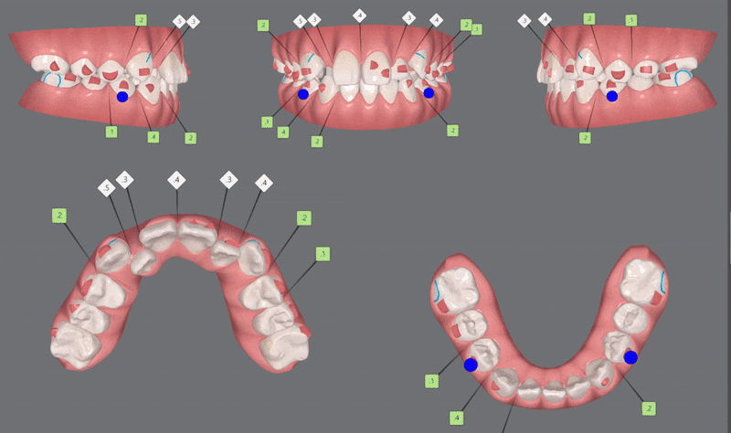 2024년 송파구 단일 치과의원급 중 유일!!! 인비절라인다이아몬드등급 달성한 유펜바른치과의 청소년인비절라인 후기 (청소년반대교합 어린이반대교합 잠실인비절라인잘하는치과) 관련 이미지 10