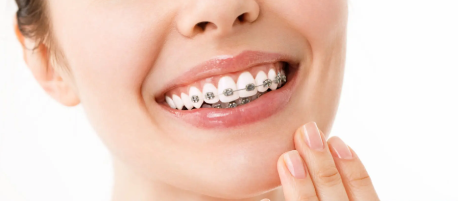 RECEIVING NON-EXTRACTION GENERAL ORTHODONTIC TREATMENT FROM AN ENGLISH-SPEAKING SPECIALIST IN KOREA 관련 이미지 1