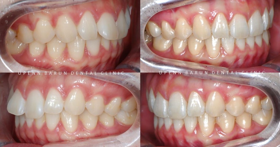 앞니부분교정 인비절라인라이트로 해결하기 (잠실인비절라인치과 송파인비절라인치과 잠실새내인비절라인치과 강동인비절라인치과 헬리오시티인비절라인 송파역인비절라인 석촌역인비절라인) 관련 이미지 14