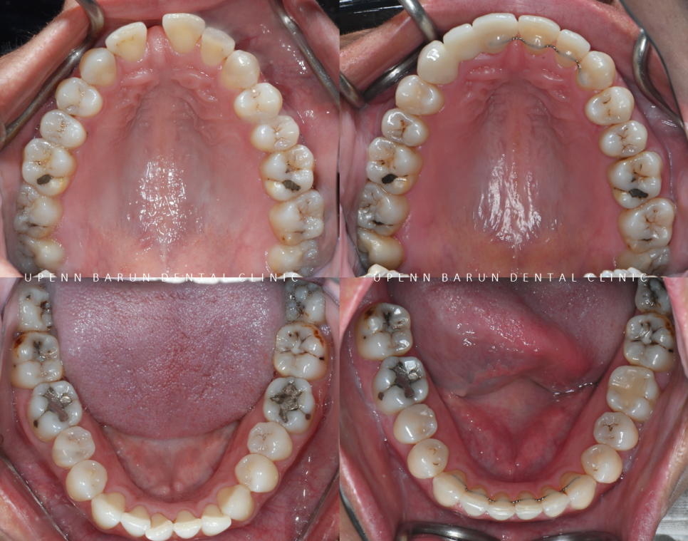 같은원장님께 보철치료와 교정치료를 동시에! 앞니사이 틈 해결한 후기 ( 송파교정치과 잠실교정잘하는치과 송파교정잘하는치과 올림픽파크포레온교정치과 올림픽파크포레온인비절라인치과) 관련 이미지 8