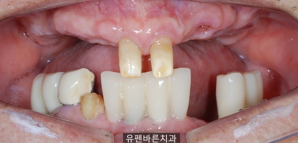 연세가 엄청 많으신데도 전체 임플란트 수술이 가능하다구요? 관련 이미지 5