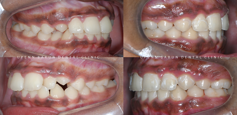 성장기에 돌출입이 고민이라면? 돌출입청소년교정 입술무력증 해결도 유펜바른치과에서! (잠실청소년교정 잠실돌출입교정 돌출입교정기간 발치교정외모변화 외국인교정치과) 관련 이미지 12