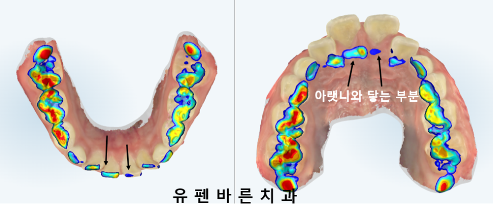 우리아이, 무턱교정 해야할까요? 관련 이미지 4